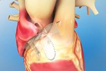 Atrioventricular (AV) Septal Defect: Repair