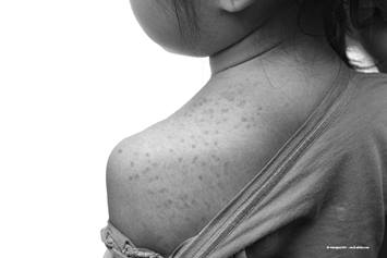 measles on a child's shoulder