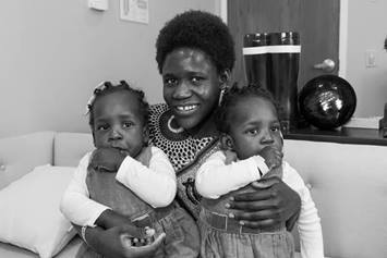 conjoined twins post surgery