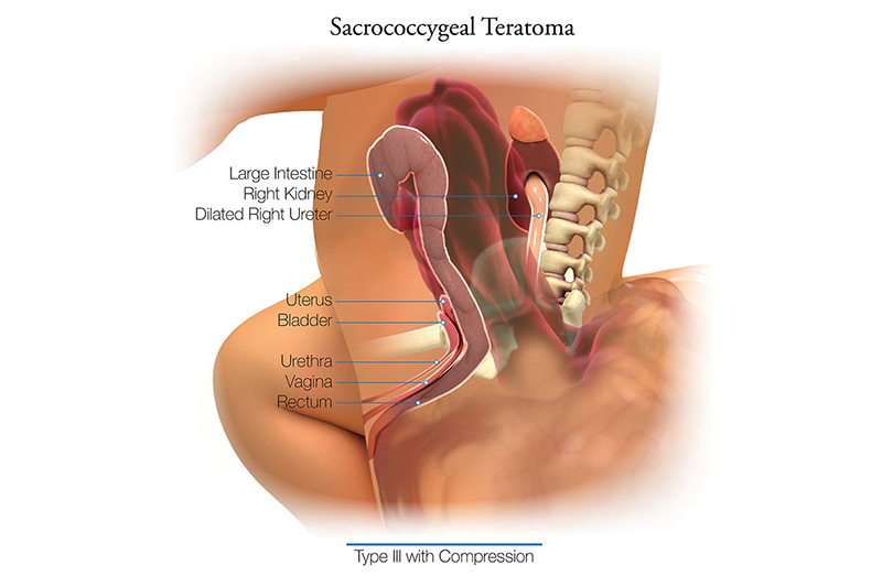 Sacrococcygeal Teratoma Type3