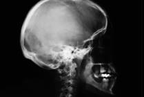 Traumatic Brain Injury