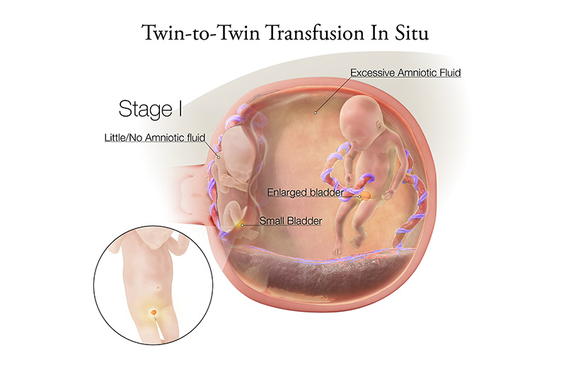 Twin to Twin Transfusion Syndrome Stage 1