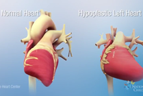Normal Heart vs. Hypoplastic Left Heart Syndrome