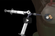 Small Cyst Treatment