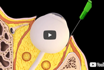 Bent Needle Technique